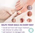 Extra Strong Nail Fungus Treatment Spray - 100ml 2