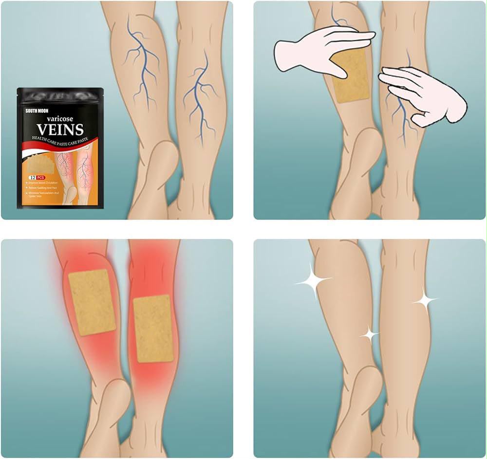 South Moon Varicose Veins Health Care Patch | 12 Pcs | Improve Circulation & Relieve Swelling