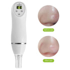 Electric Pore Suction &amp; Acne Removing Beauty Cleaner 2